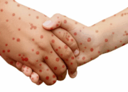 Waspada! Campak jadi Komplikasi Sebabkan Penyakit Berat