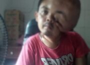 Viqri Penderita Tumor Ganas di Pesisir Selatan Butuh Uluran Tangan Dermawan