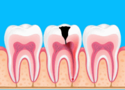 Hasil CKG, Warga Indonesia Banyak Sakit Gigi