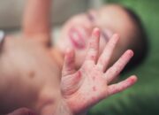 Kasus Campak dan Cacar Air Meningkat di Pariaman